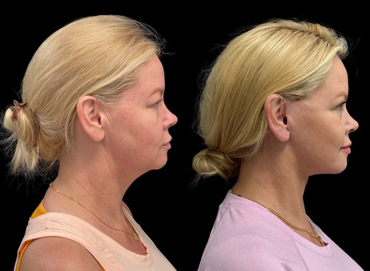 Facelift before and after photos by Dr. Demetri Arnaoutakis in Tampa, FL