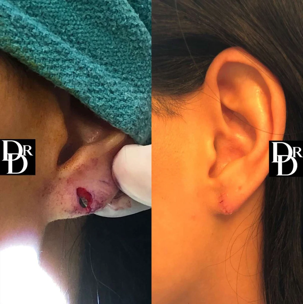 Earlobe Repair before and after photos by Dr. Demetri Arnaoutakis in Tampa, FL