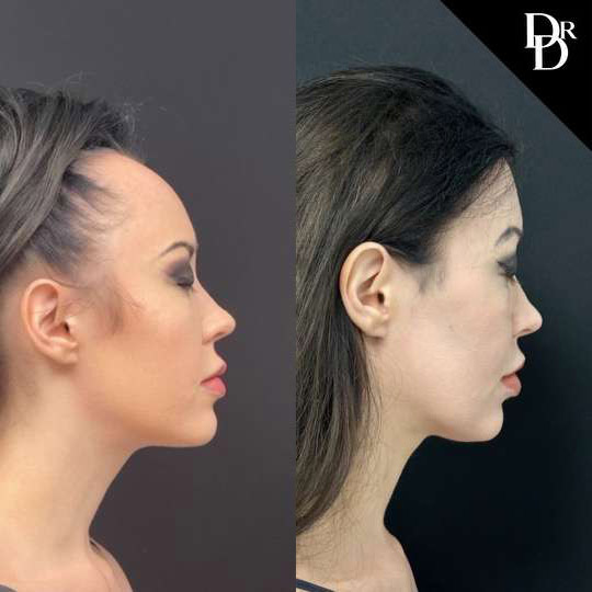 Hairline Lowering Surgery before and after photos by Dr. Demetri Arnaoutakis in Tampa, FL