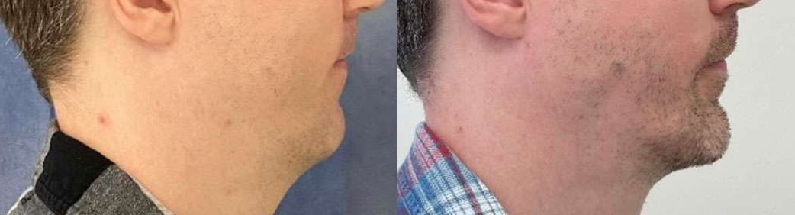 Chin Augmentation before and after photos by Dr. Demetri Arnaoutakis in Tampa, FL