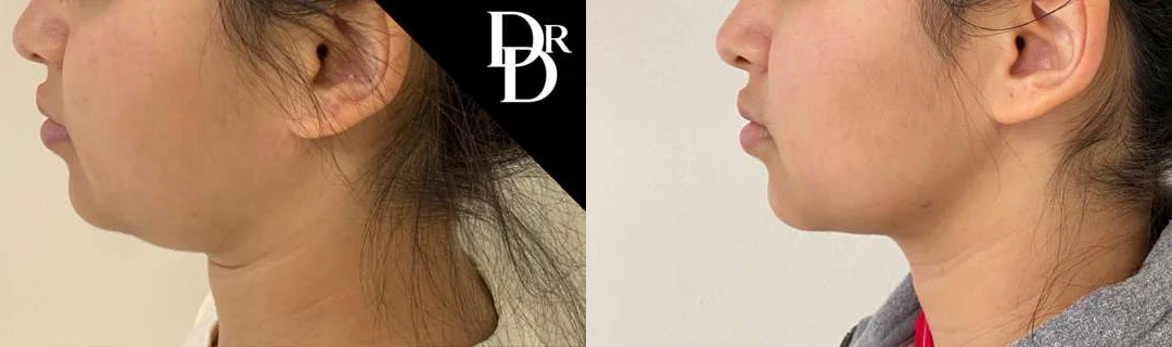 Neck Lift before and after photos by Dr. Demetri Arnaoutakis in Tampa, FL