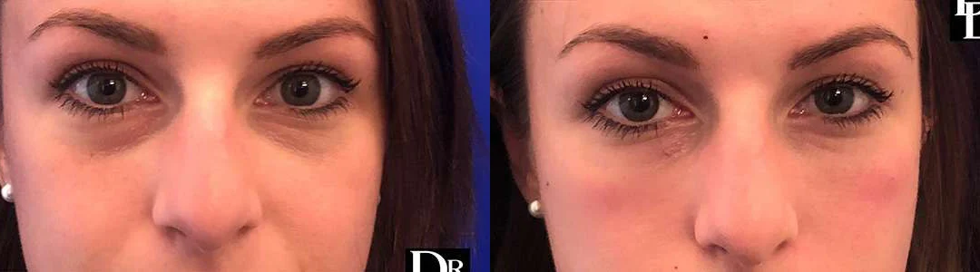 Injectable/Dermal Fillers before and after photos by Dr. Demetri Arnaoutakis in Tampa, FL