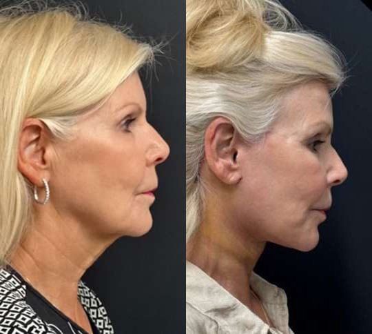 Facelift before and after photos by Dr. Demetri Arnaoutakis in Tampa, FL