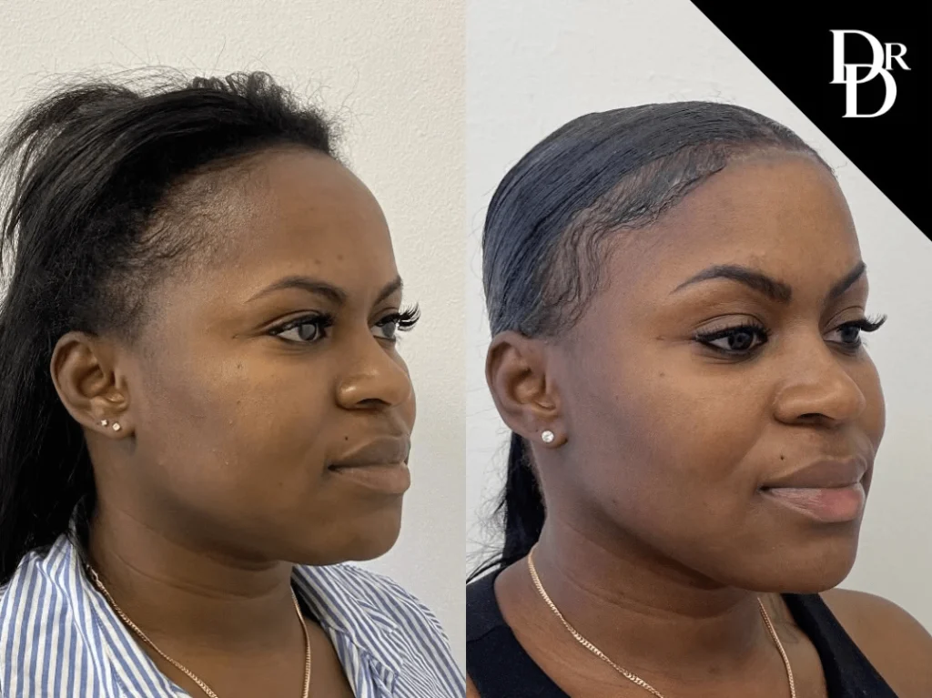 Hairline Lowering Surgery before and after photos by Dr. Demetri Arnaoutakis in Tampa, FL