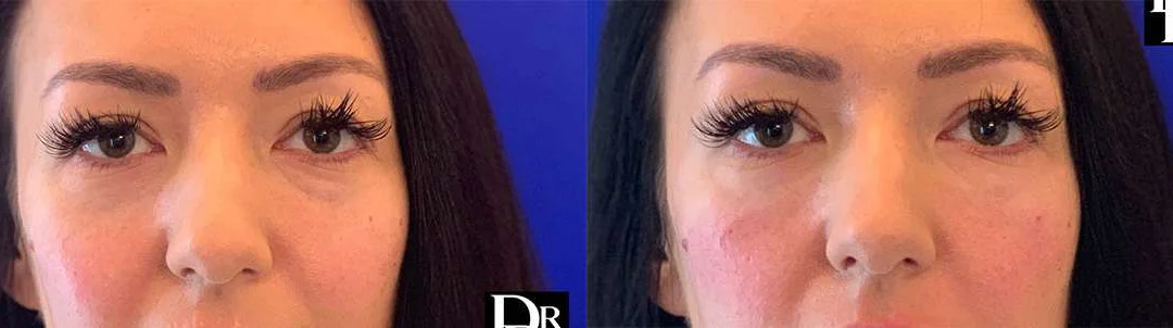 Injectable/Dermal Fillers before and after photos by Dr. Demetri Arnaoutakis in Tampa, FL