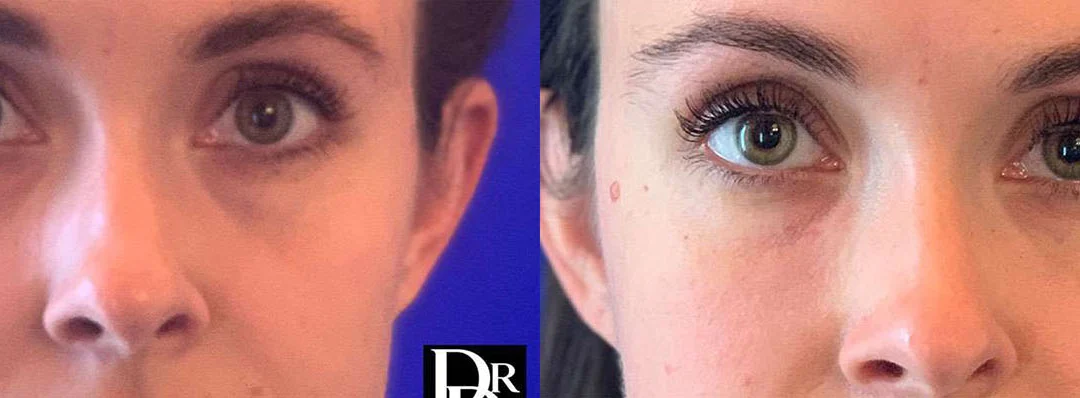 Injectable/Dermal Fillers before and after photos by Dr. Demetri Arnaoutakis in Tampa, FL