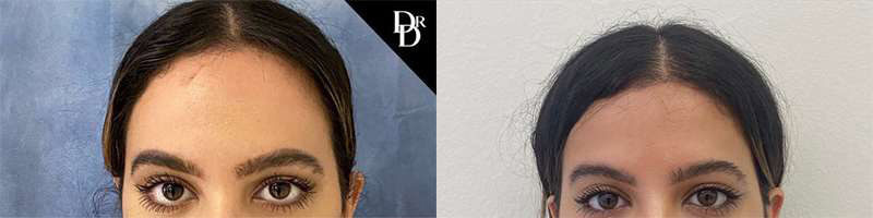 Hairline Lowering Surgery before and after photos by Dr. Demetri Arnaoutakis in Tampa, FL