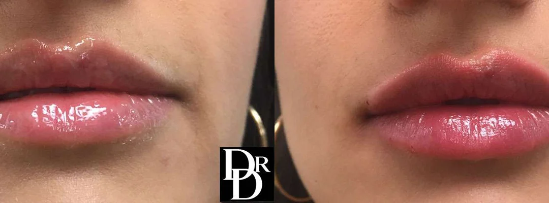 Injectable/Dermal Fillers before and after photos by Dr. Demetri Arnaoutakis in Tampa, FL