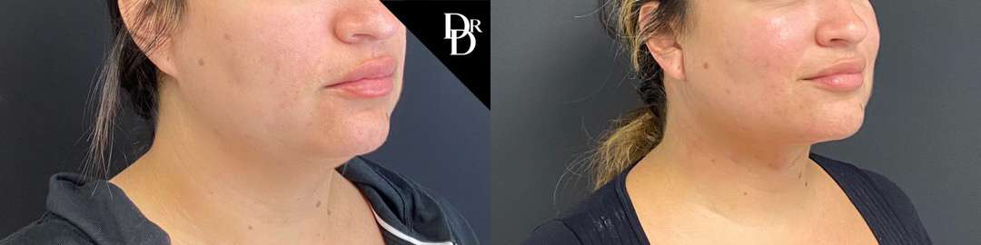 Neck Lift before and after photos by Dr. Demetri Arnaoutakis in Tampa, FL