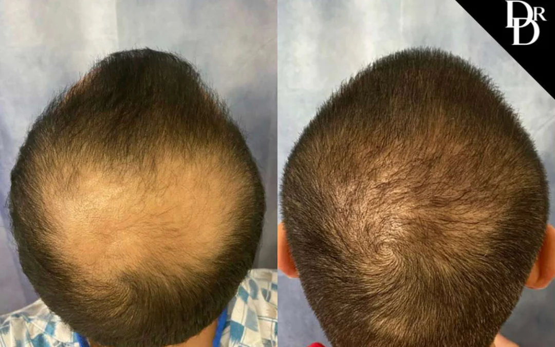 Hair Transplant before and after photos by Dr. Demetri Arnaoutakis in Tampa, FL