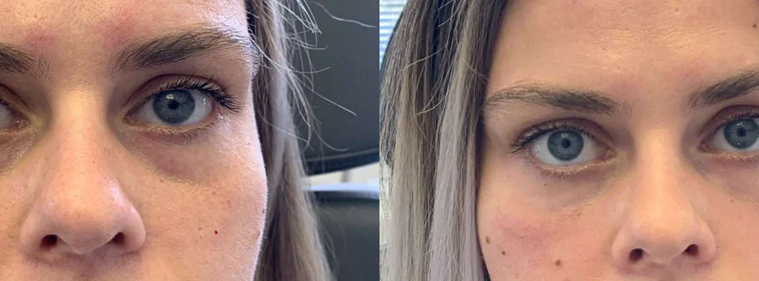 Injectable/Dermal Fillers before and after photos by Dr. Demetri Arnaoutakis in Tampa, FL