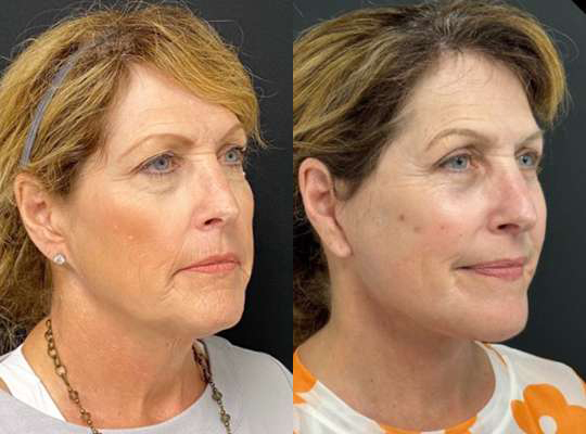 Facelift before and after photos by Dr. Demetri Arnaoutakis in Tampa, FL