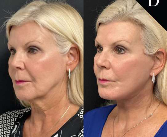 Facelift before and after photos by Dr. Demetri Arnaoutakis in Tampa, FL