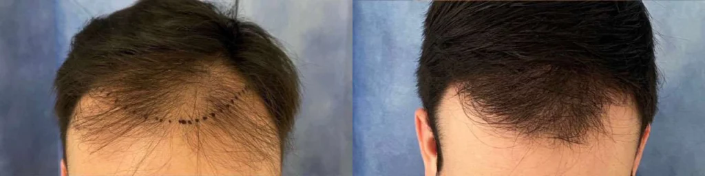 Hair Transplant before and after photos by Dr. Demetri Arnaoutakis in Tampa, FL