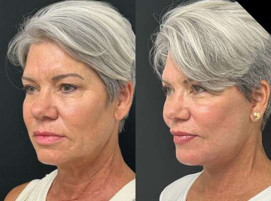 Facelift before and after photos by Dr. Demetri Arnaoutakis in Tampa, FL