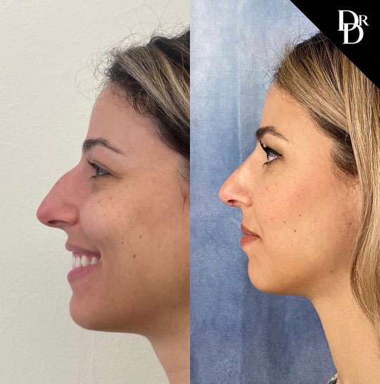 Rhinoplasty before and after photos by Dr. Demetri Arnaoutakis in Tampa, FL