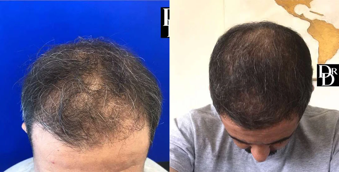 Hair Transplant before and after photos by Dr. Demetri Arnaoutakis in Tampa, FL