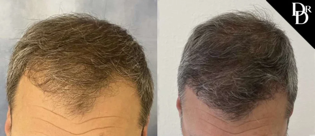 Hair Transplant before and after photos by Dr. Demetri Arnaoutakis in Tampa, FL