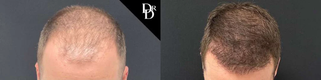 Hair Transplant before and after photos by Dr. Demetri Arnaoutakis in Tampa, FL