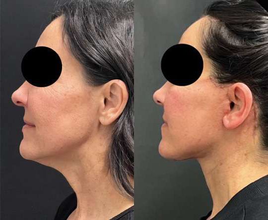 Facelift before and after photos by Dr. Demetri Arnaoutakis in Tampa, FL