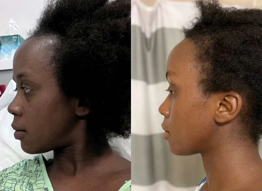 Hairline Lowering Surgery before and after photos by Dr. Demetri Arnaoutakis in Tampa, FL