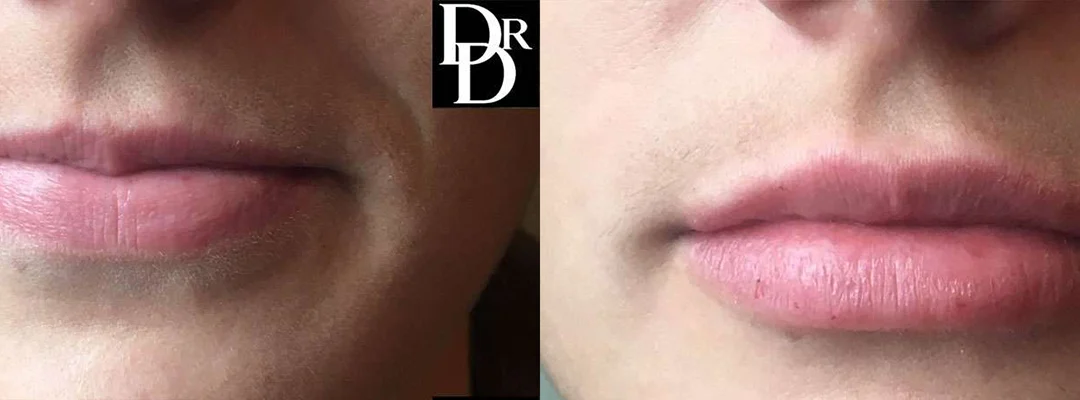 Injectable/Dermal Fillers before and after photos by Dr. Demetri Arnaoutakis in Tampa, FL