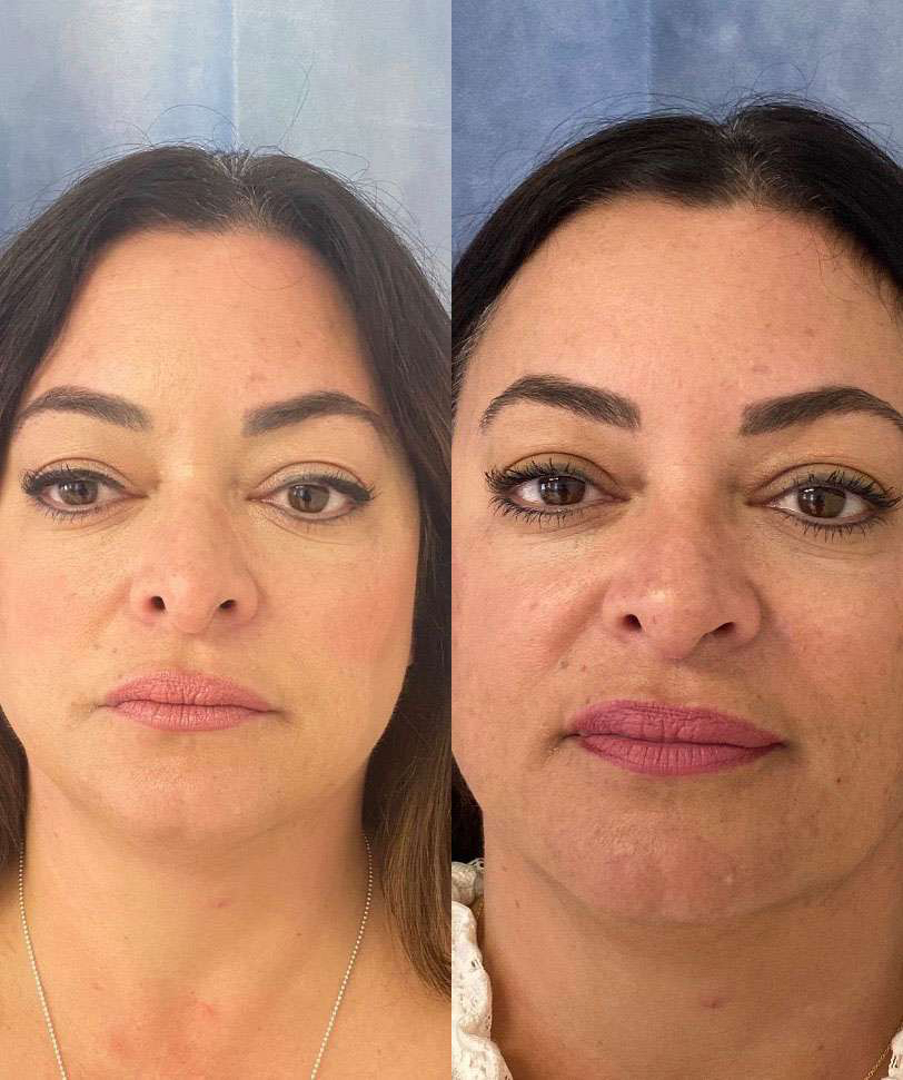 Rhinoplasty before and after photos by Dr. Demetri Arnaoutakis in Tampa, FL