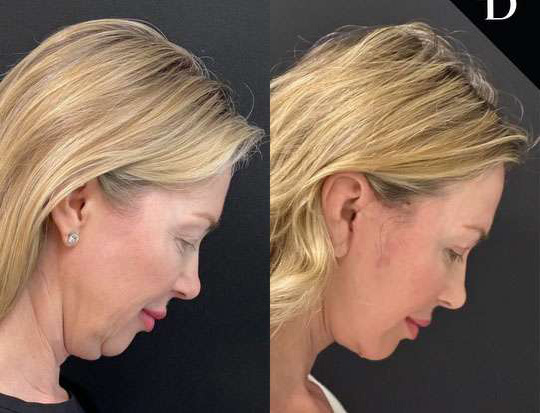 Facelift before and after photos by Dr. Demetri Arnaoutakis in Tampa, FL