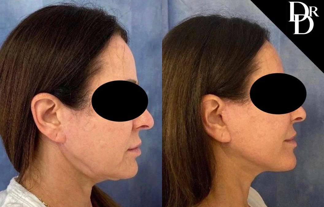 Facelift before and after photos by Dr. Demetri Arnaoutakis in Tampa, FL