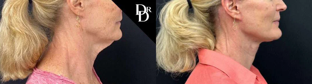 Facelift before and after photos by Dr. Demetri Arnaoutakis in Tampa, FL