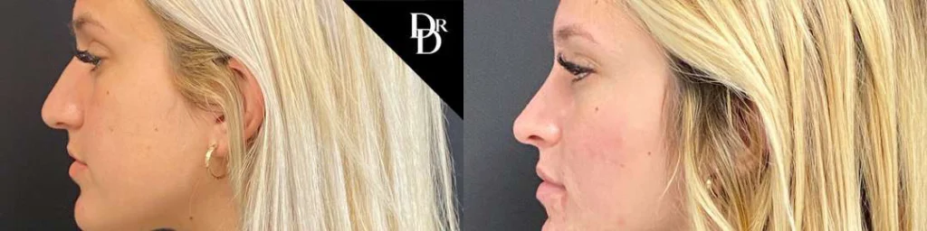 Rhinoplasty before and after photos by Dr. Demetri Arnaoutakis in Tampa, FL