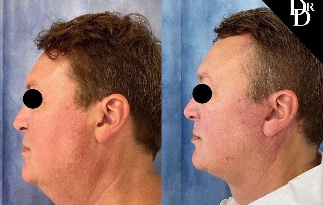 Facelift before and after photos by Dr. Demetri Arnaoutakis in Tampa, FL