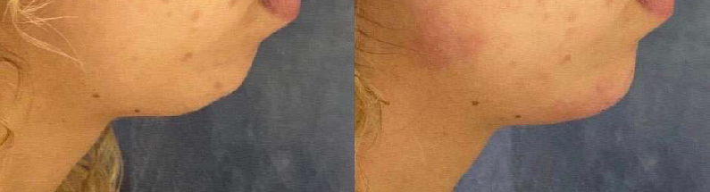 Chin Augmentation before and after photos by Dr. Demetri Arnaoutakis in Tampa, FL