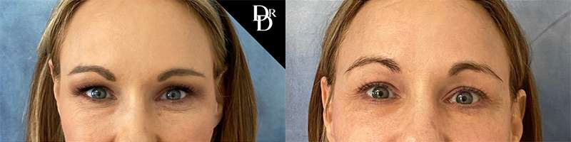 Eyelid Surgery before and after photos by Dr. Demetri Arnaoutakis in Tampa, FL