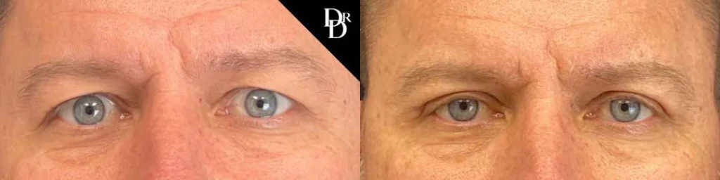 Eyelid Surgery before and after photos by Dr. Demetri Arnaoutakis in Tampa, FL