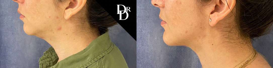 Neck Lift before and after photos by Dr. Demetri Arnaoutakis in Tampa, FL