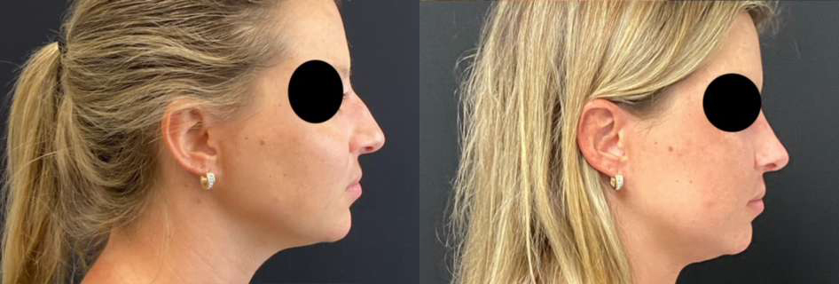 Rhinoplasty before and after photos by Dr. Demetri Arnaoutakis in Tampa, FL