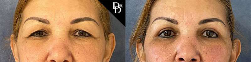 Eyelid Surgery before and after photos by Dr. Demetri Arnaoutakis in Tampa, FL