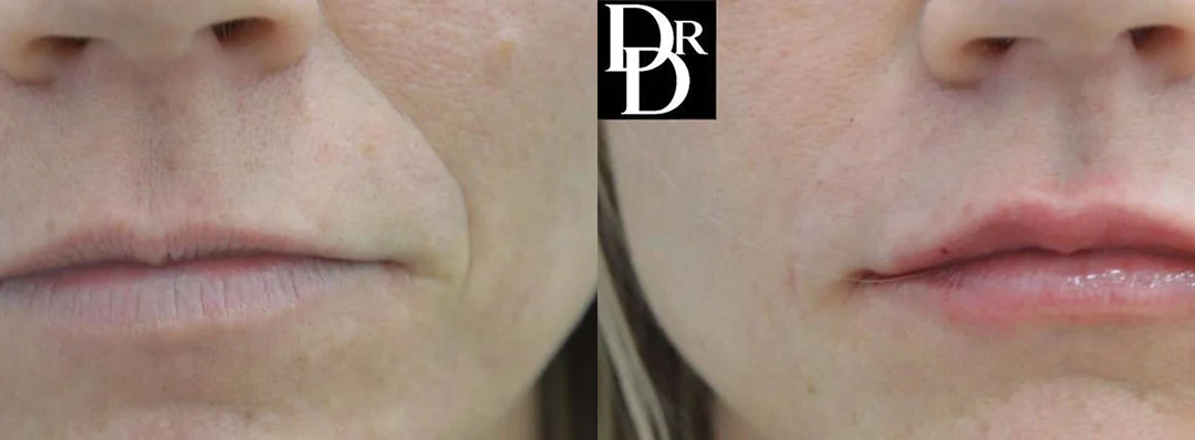 Injectable/Dermal Fillers before and after photos by Dr. Demetri Arnaoutakis in Tampa, FL