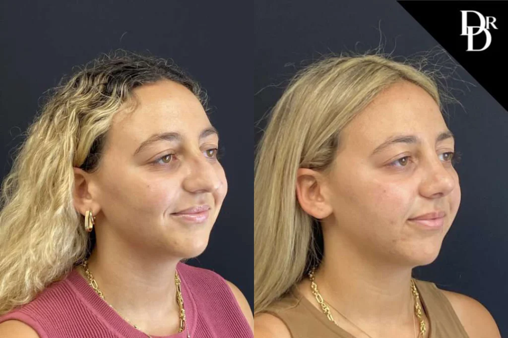 Rhinoplasty before and after photos by Dr. Demetri Arnaoutakis in Tampa, FL