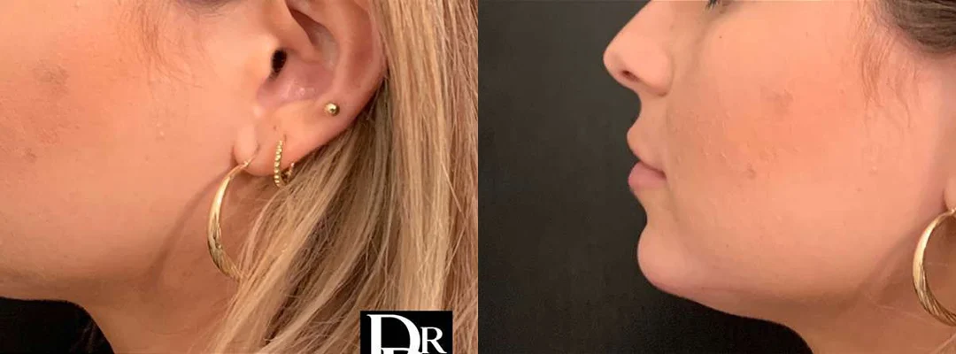 Chin Augmentation before and after photos by Dr. Demetri Arnaoutakis in Tampa, FL