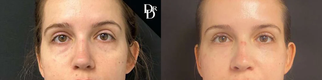 Eyelid Surgery before and after photos by Dr. Demetri Arnaoutakis in Tampa, FL