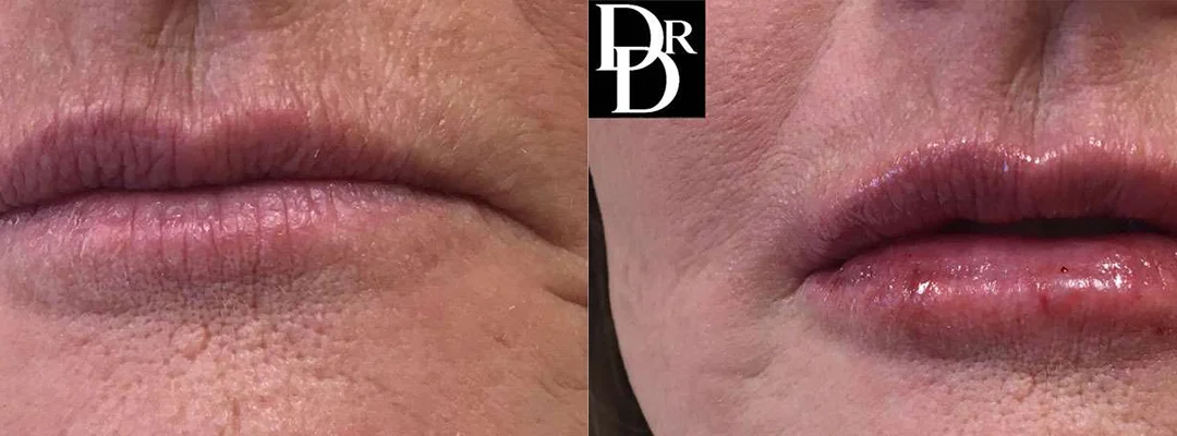 Injectable/Dermal Fillers before and after photos by Dr. Demetri Arnaoutakis in Tampa, FL