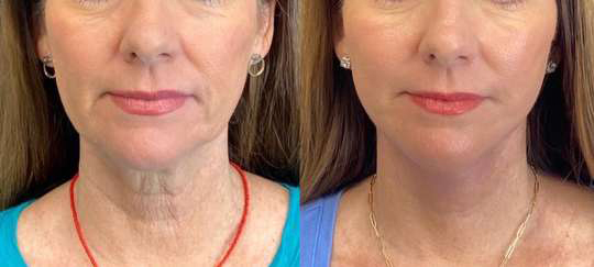 Facelift before and after photos by Dr. Demetri Arnaoutakis in Tampa, FL