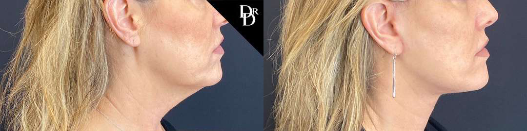 Facelift before and after photos by Dr. Demetri Arnaoutakis in Tampa, FL