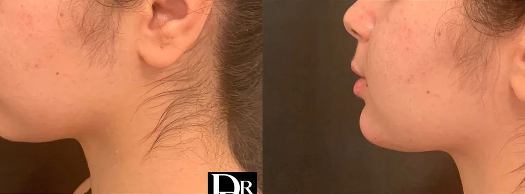 Chin Augmentation before and after photos by Dr. Demetri Arnaoutakis in Tampa, FL