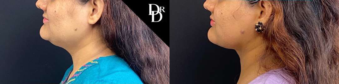 Neck Lift before and after photos by Dr. Demetri Arnaoutakis in Tampa, FL