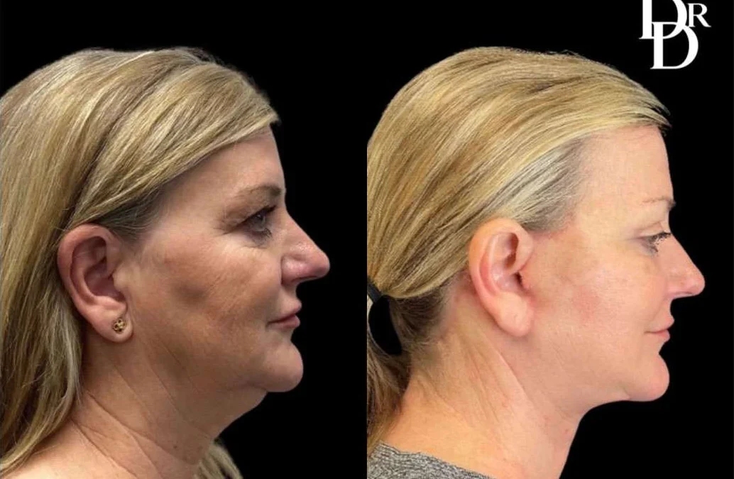 Facelift before and after photos by Dr. Demetri Arnaoutakis in Tampa, FL