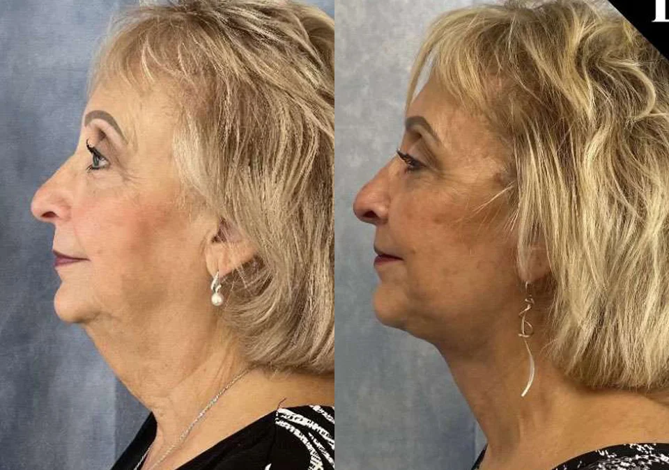 Facelift before and after photos by Dr. Demetri Arnaoutakis in Tampa, FL