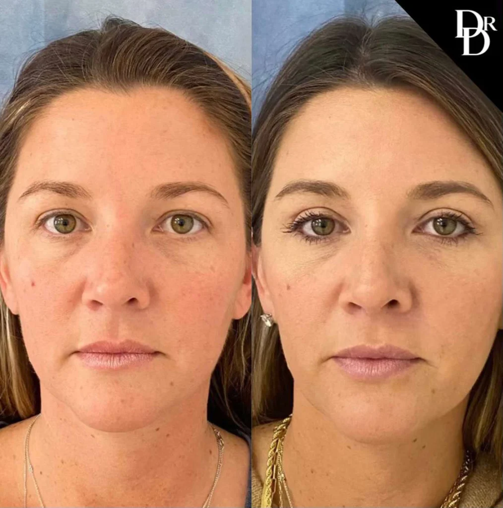 Eyelid Surgery before and after photos by Dr. Demetri Arnaoutakis in Tampa, FL